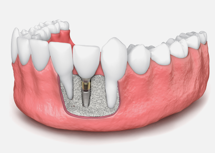 Bone Grafting