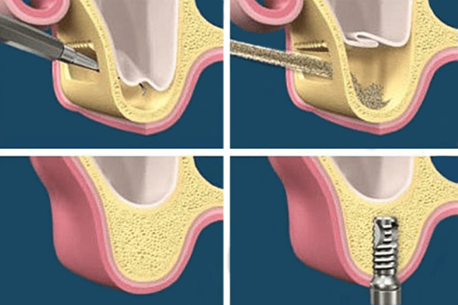 Sinus Lifts