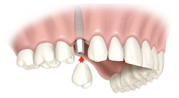 Implants For Single Or Multiple Teeth